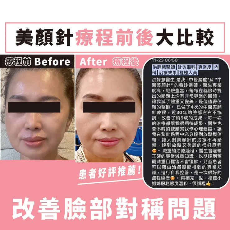美顏針療程前後大比較