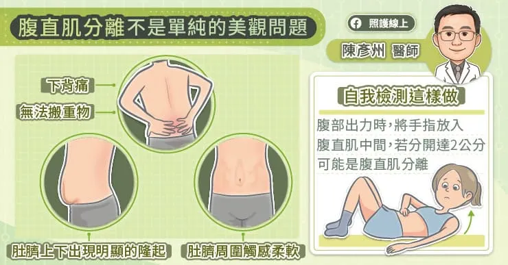 腹直肌分離不是單純的美觀問題