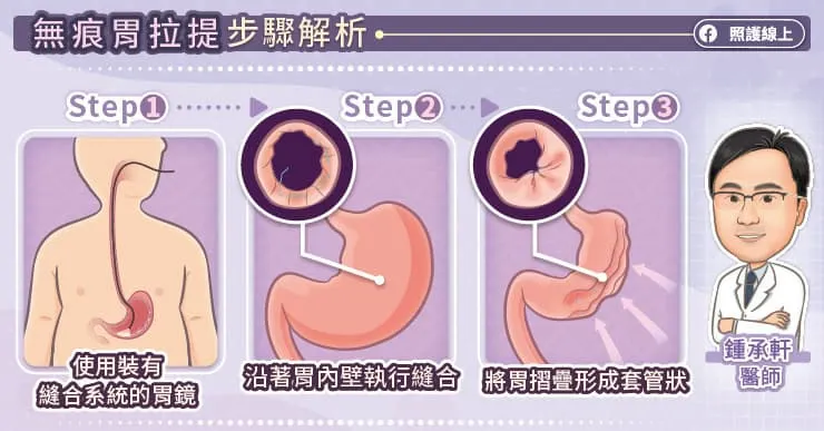 無痕胃拉提步驟