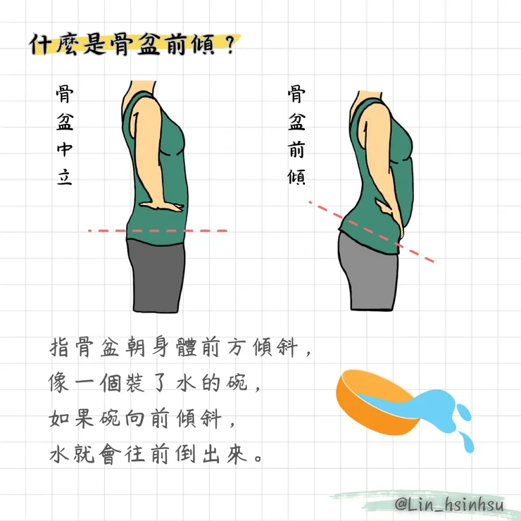 什麼是骨盆前傾？
