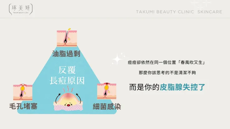 告別反覆長痘！Neobeam 清新光為何是「成年痘、壓力痘」的終結者？