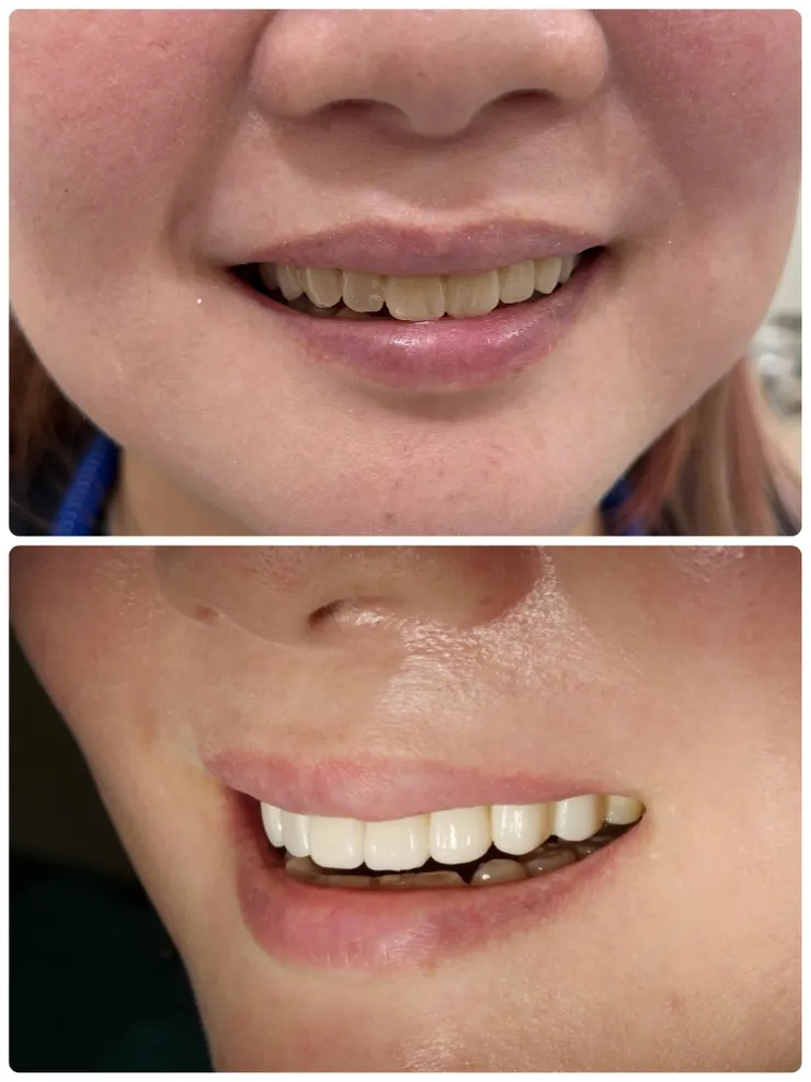 渥爾牙醫診所：大安區頂級美白牙齒貼片！不必等待的笑容蛻變，立即打造自信光采！