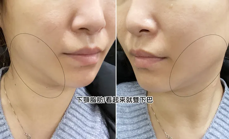 台北打雙下巴│ONDA超微波（昂達），台北醫美診所推薦【旭彤診所】