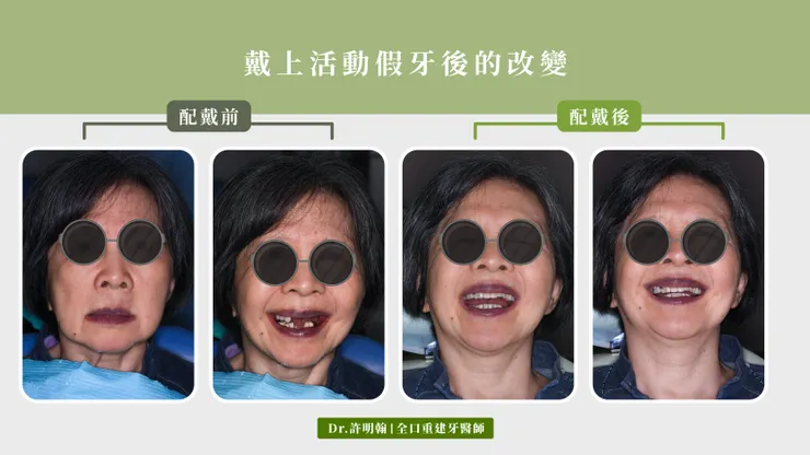 活動假牙的配戴前後對比