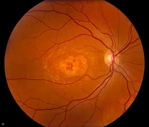 Stargradt disease and macular dystrophy—Lighthouse