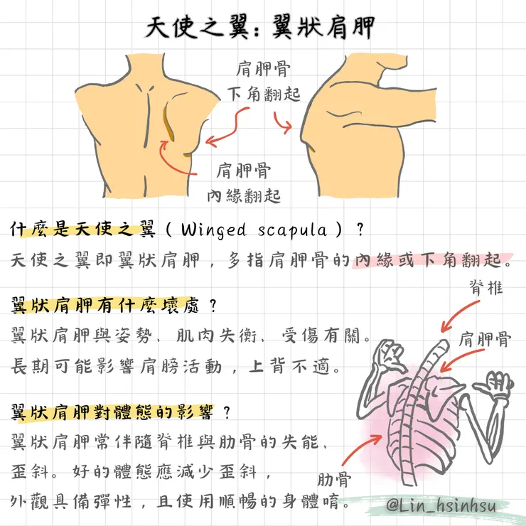 翼狀肩胛的原因與影響