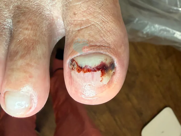 指甲瘀青台北板橋維妮問題指甲