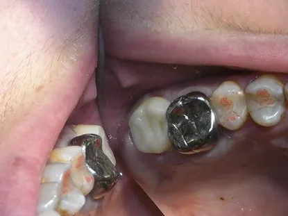 渥爾牙醫診所:蛀蝕深入牙肉下的修復挑戰!Cap-Lock全瓷系列拯救上顎第二大臼齒!