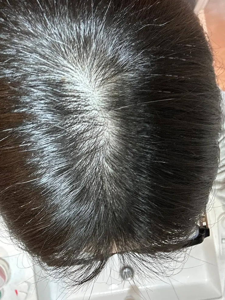 這是我稀疏的頭皮
