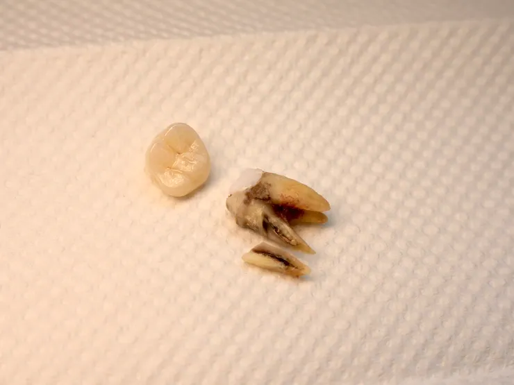 渥爾牙醫提醒！氧化鋯牙冠雖然很硬，但你還是不能亂咬！