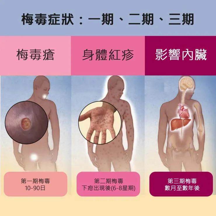梅毒第一期、第二期、第三期的主要病徵