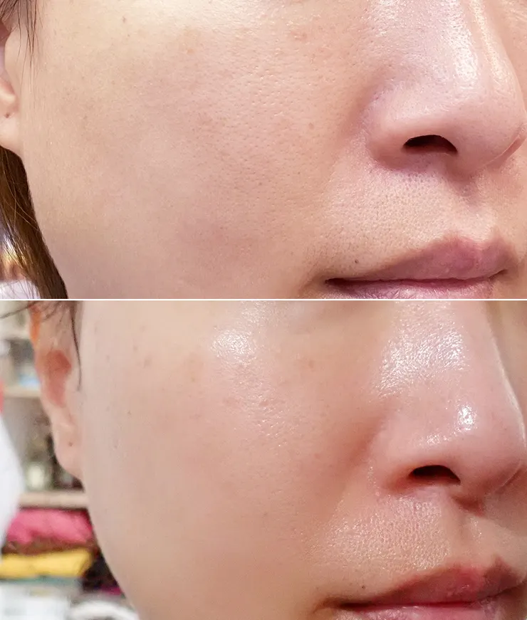 台北打皮秒│探索皮秒+蜂巢(超級鏡片ReFIX)-台北醫美診所推薦