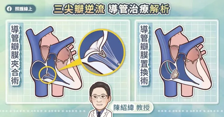 三尖瓣逆流導管治療