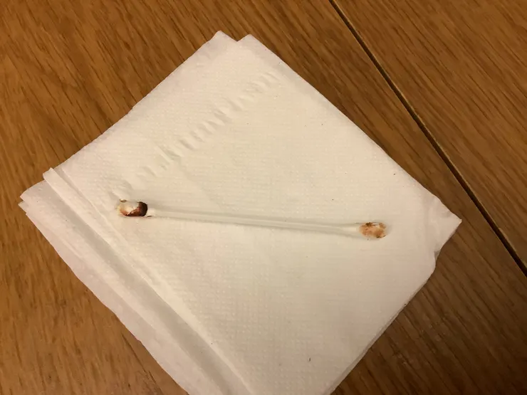 圖一：左耳棉花棒沾黏排出血色髒物