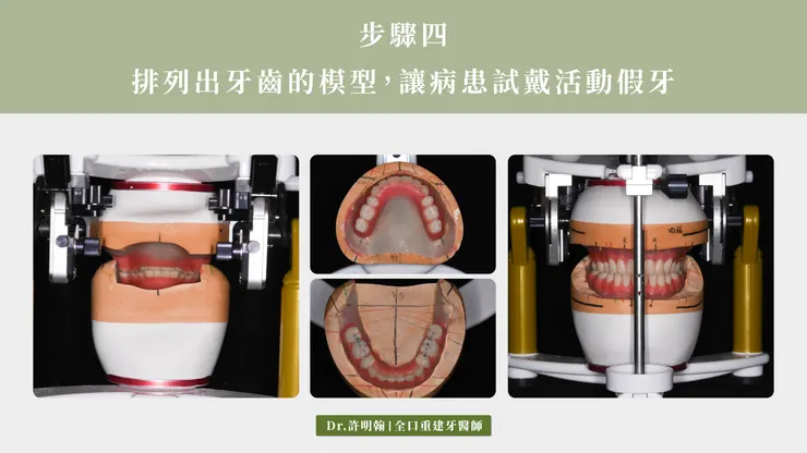 排列牙齒的模型讓病患試戴活動假牙