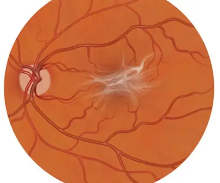 Macular Pucker-AAO