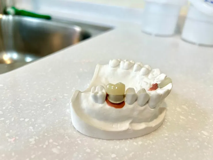 渥爾牙醫診所：植牙不只要穩，更要懂得「避震」！認識Bio-HPP新材料植體假牙