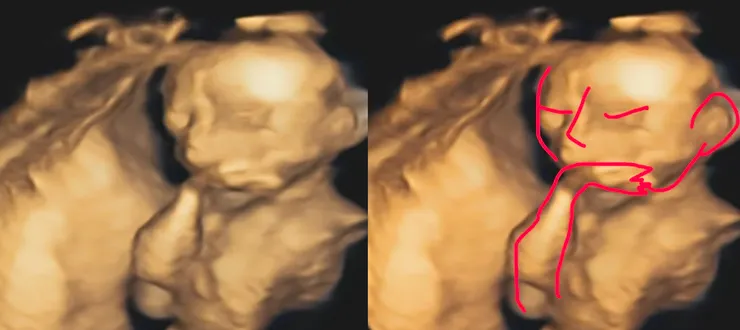 郭醫師說我的寶寶是沉思者！