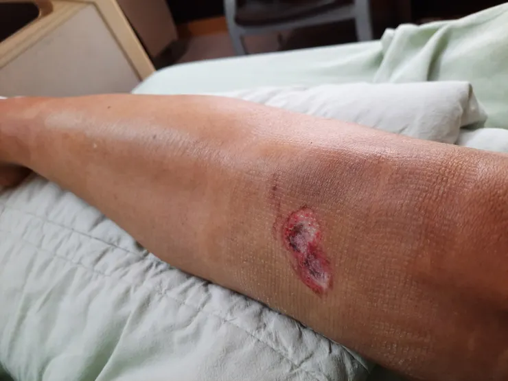 4月的膝蓋擦傷磨到白白黑黑了