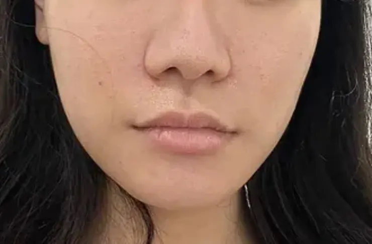 凝境美學 玻尿酸法令紋當下