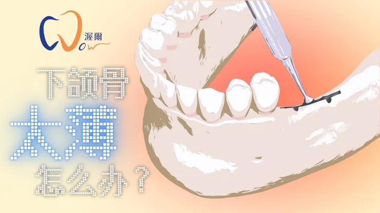 植牙手術小百科：骨頭太薄不能植牙？「劈骨擴張術(劈骨)」是關鍵！