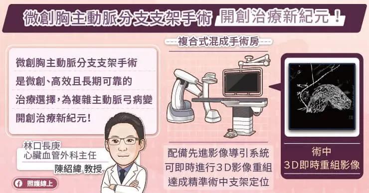 微創胸主動脈分支支架手術開創治療新紀元