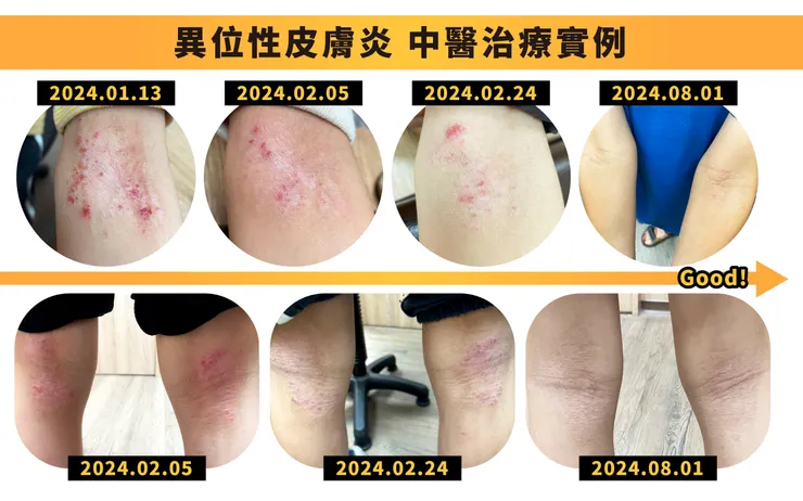異位性皮膚炎中醫治療實例