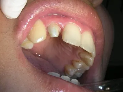 渥爾牙醫診所：Cap-Lock全瓷牙冠安裝，回診、追蹤！