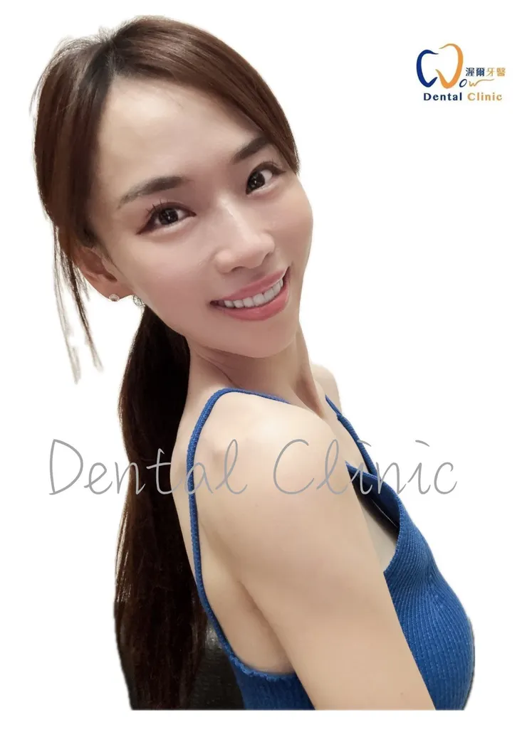 笑容蛻變日記!蔣小姐的笑容大改造!渥爾牙醫診所「明眸鋯齒」牙齒美白貼片讓你擁有自信笑容!