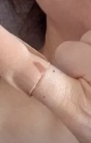 這兩個可愛的小眼睛就是打麻醉劑的痕跡