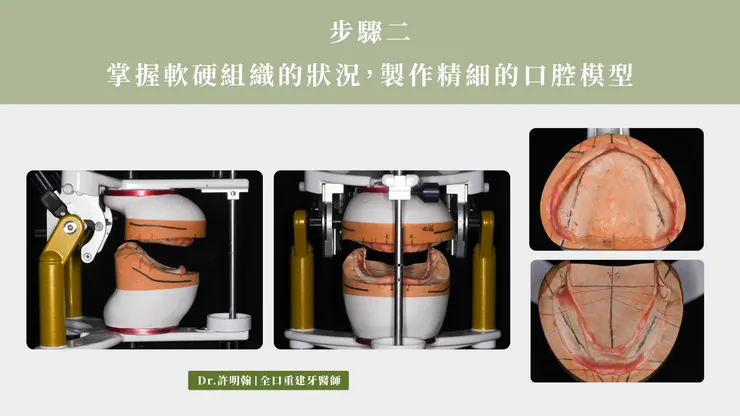 步驟二 掌握軟硬組織的狀況 製作精細的口腔模型