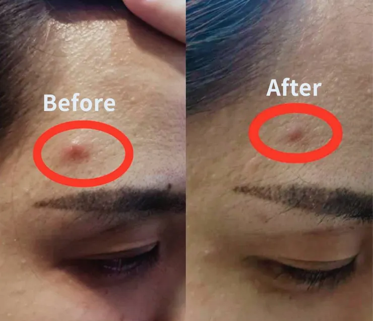 爆痘時，濕敷何謂美HEIWEI魚子亮白保濕化妝水，鎮靜紅腫的痘痘。