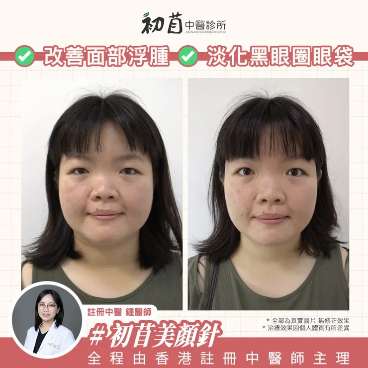 美顏針 , 面部針灸 , 25歲後我開始容貌焦慮