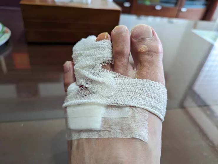 醫生:樓梯滑倒到腳掌裂開第一次聽到。我:嗚嗚嗚:(