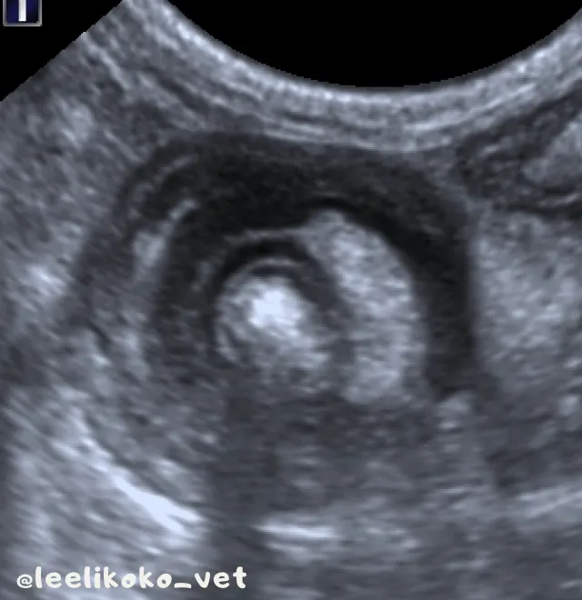 腹腔超音波- 腸套疊位置橫切面