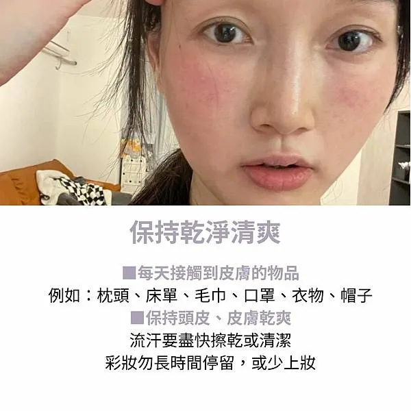 脂漏性皮膚炎要注意什麼