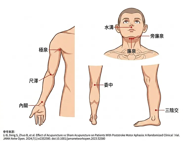 中風失語穴位參考