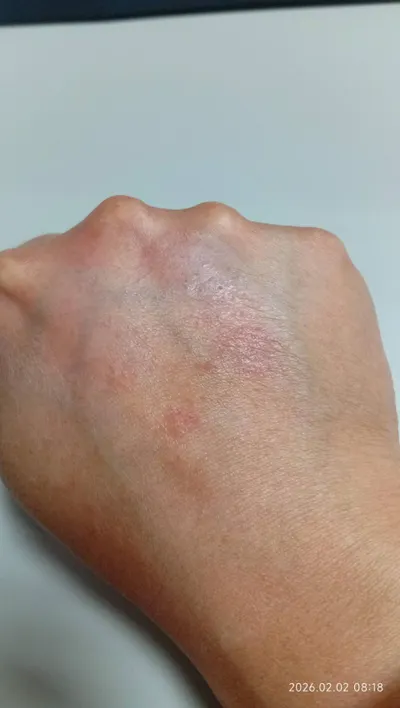 濕疹記錄-2