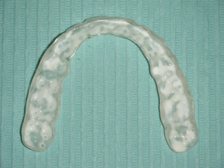 擠一點點，隨便塗在牙齒上，用舌頭抹勻，再戴上透明維持器，幾次試誤之後，您就知道適合自己的份量了