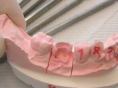 渥爾牙醫診所: Cap-Lock全瓷系列修復案例!斜裂下大臼齒的成功修復!