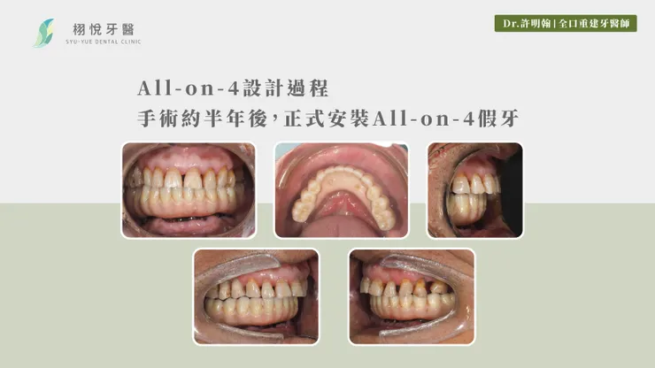 All-on-4設計過程：手術約半年後，正式安裝All-on-4假牙