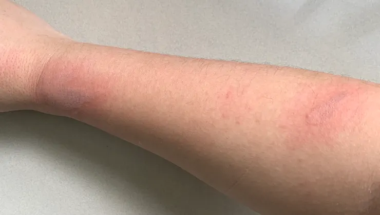 沖水45分鐘後跟冰敷後的傷口