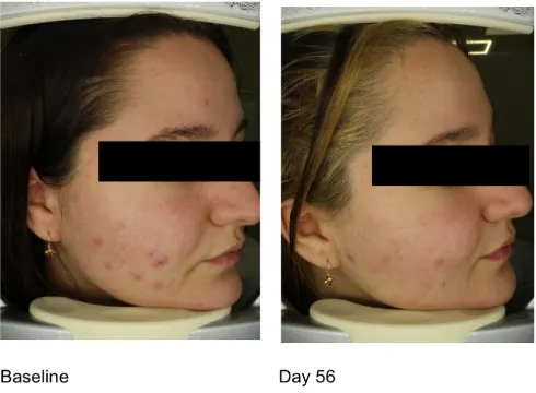 (其中一受試者，使用前vs使用後：臉部痘痘顯著改善。擷取自該報告FIGURE 6 (A))