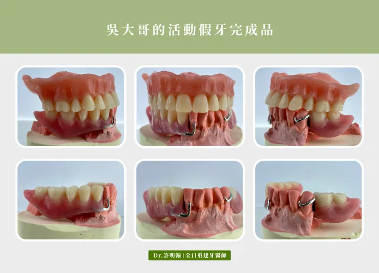 活動假牙的完成品