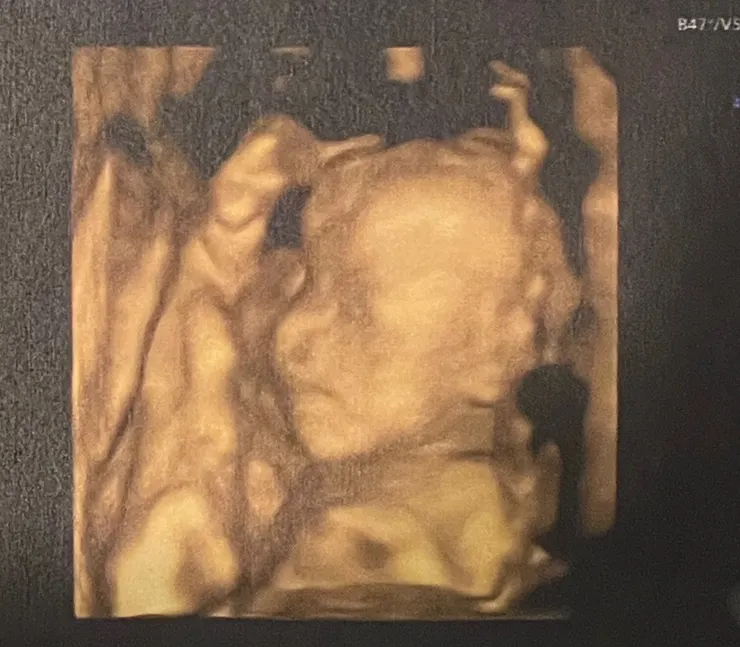 22週寶寶高層次超音波像/Ching拍攝