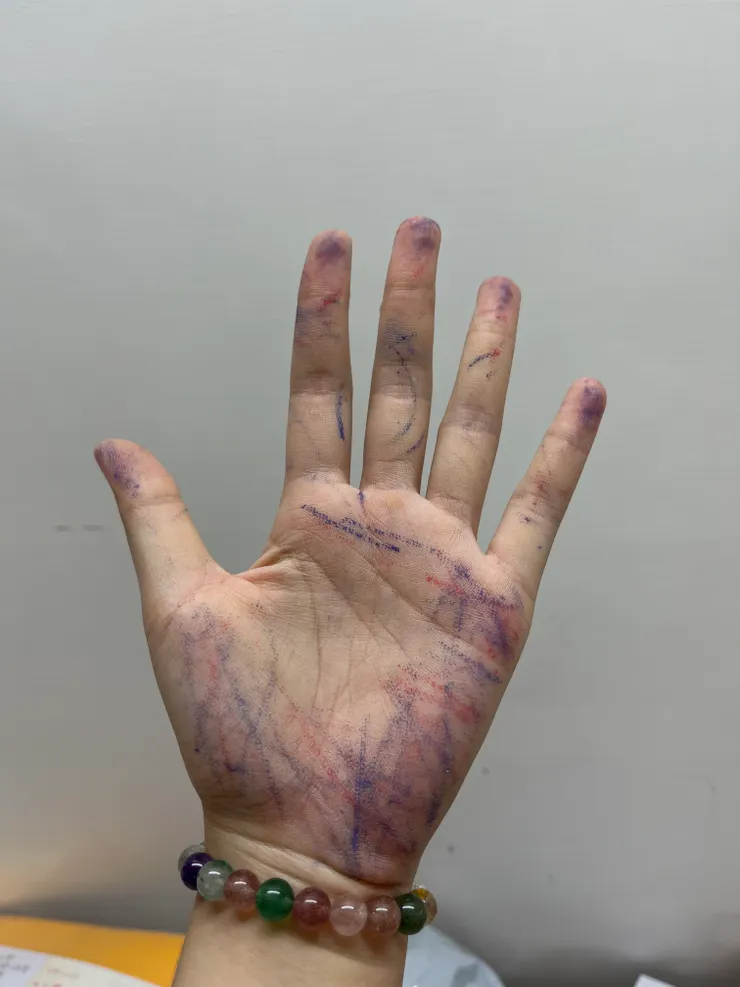 被熱消筆轉印成不成手樣(?)