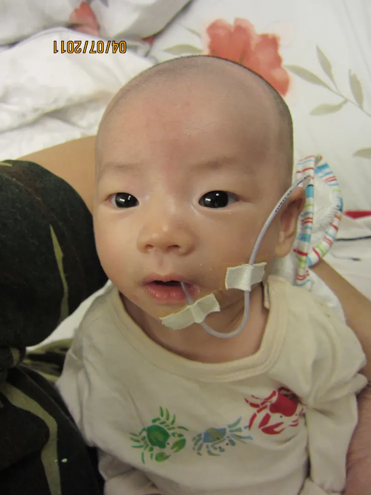 跟其他的孩子在一起很明顯的不一樣。〔口餵管〕