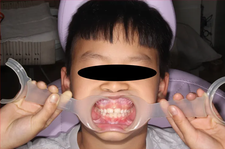 傳統雙手拉開的開口器，通常是助理拉，但有時我會請小朋友自己拉，增加參與感、互動性