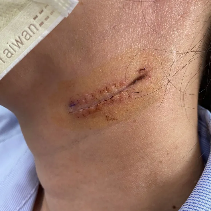 剛拆完線的傷口已經癒合