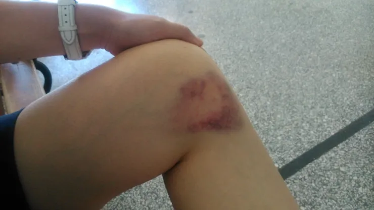 被驢子夾傷的代價